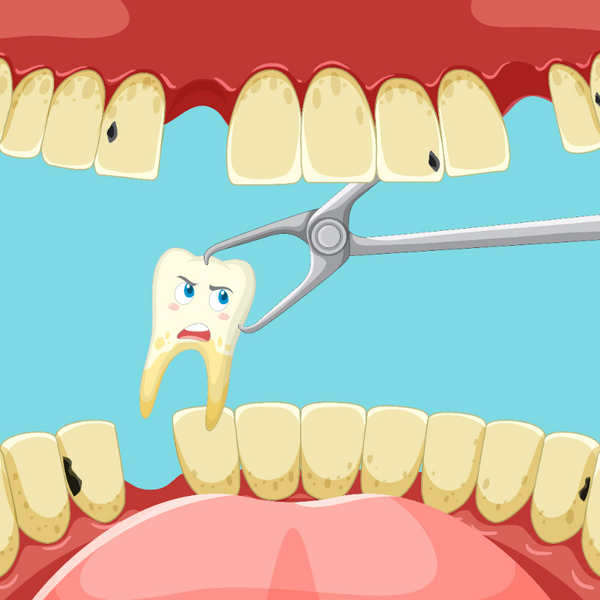 How You Should Clean Your Teeth after a Tooth Extraction